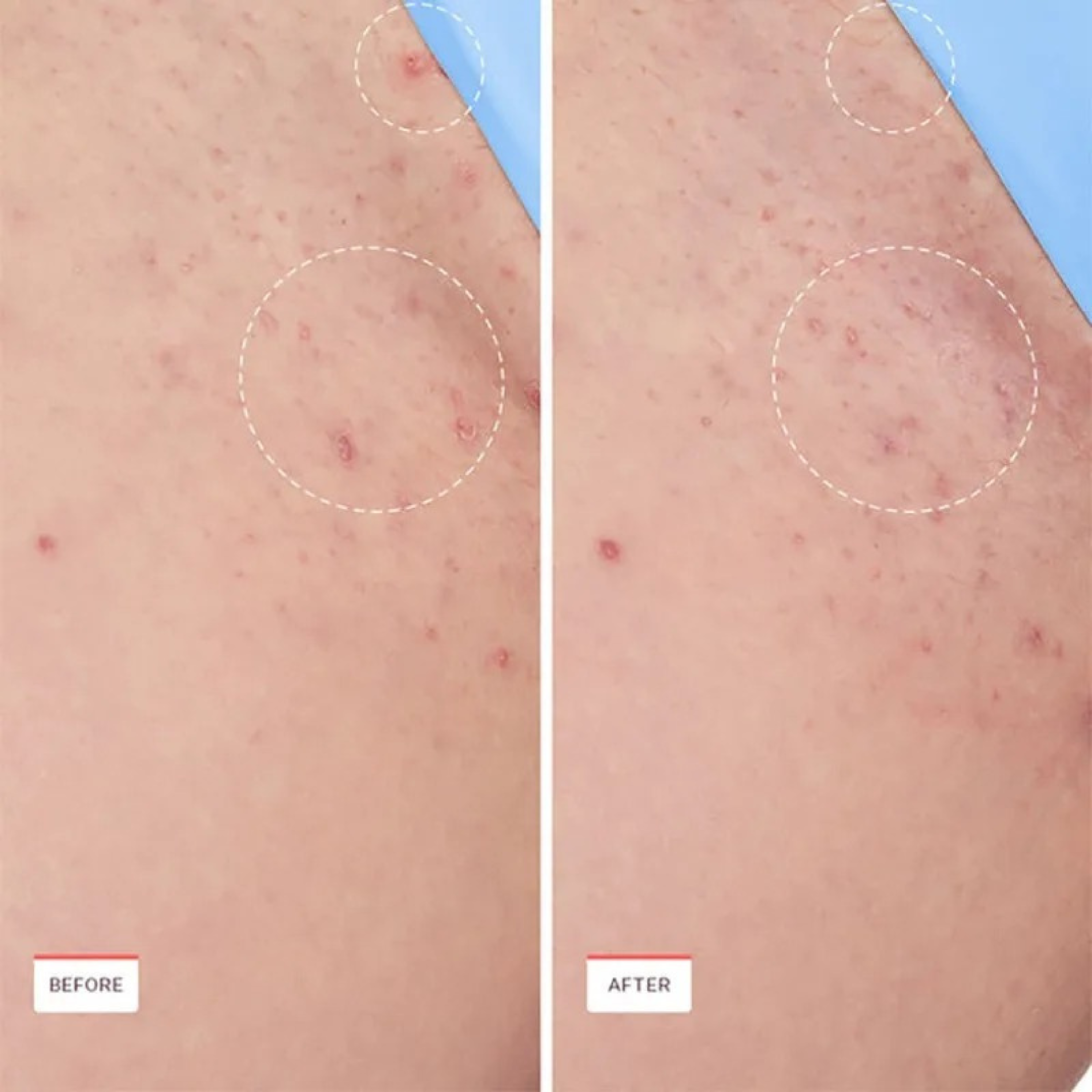 Exora™ Skin Smoothing Solution