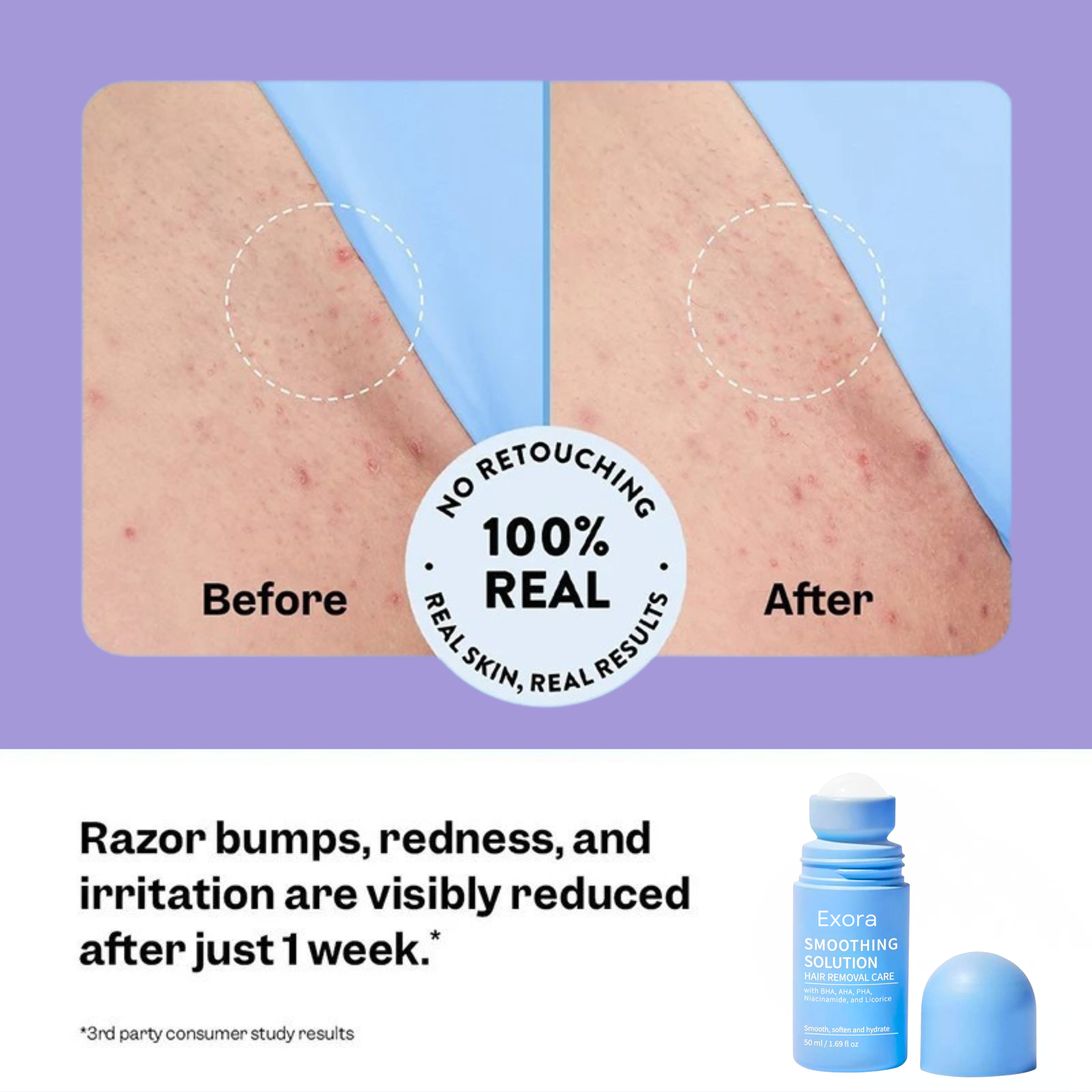 Exora™ Skin Smoothing Solution